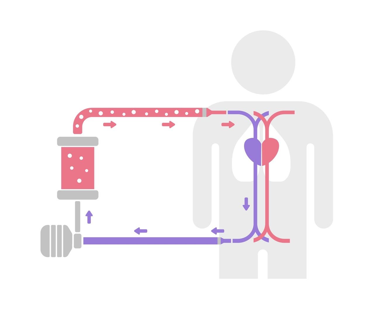 EXTRACORPOREAL MEMBRANE OXYGENATION (ECMO)